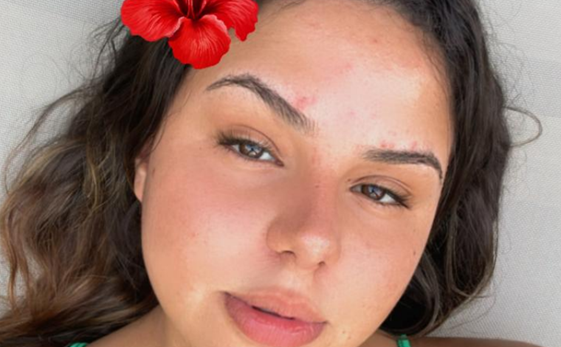 Em Jaguaquara, mãe de jovem com leucemia faz apelo por doador de medula.