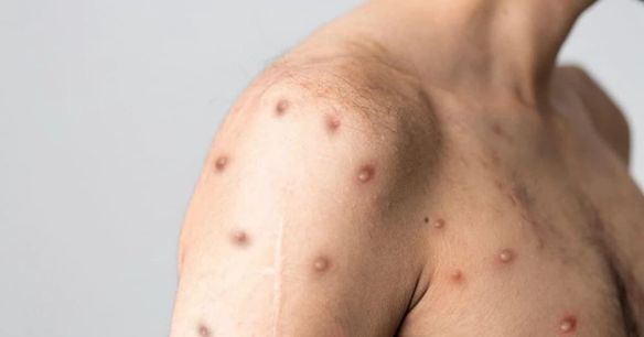 OMS declara que Mpox voltou a ser emergência sanitária global
