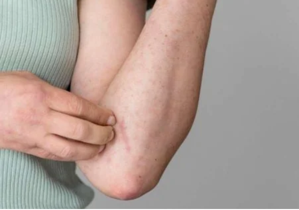 Saúde alerta para disseminação da febre Oropouche no país