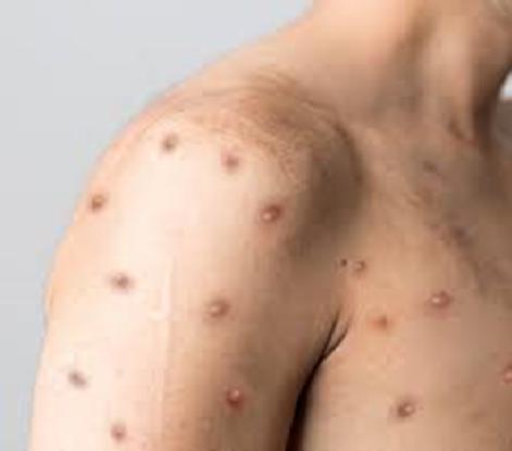 OMS alerta para variante mais perigosa de mpox