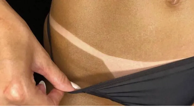 Bronzeamento artificial é proibido pela Anvisa; saiba os riscos